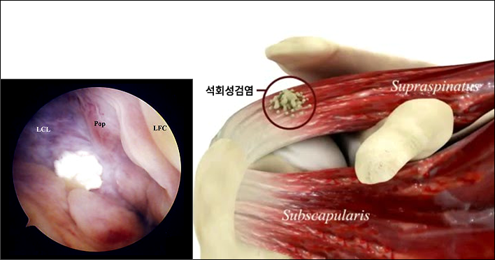 석회성건염의