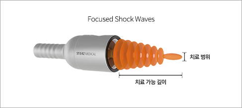집중형 체외충격파