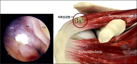 >석회성건염